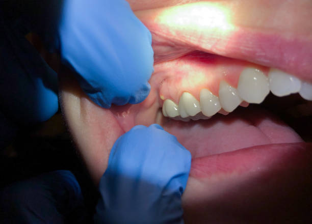 Best Emergency Root Canal Treatment in Port Ewen, NY